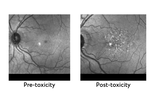 The image shows two retinal scans of the same patient. In the left photo showing pre-toxicity, the patient's scan shows minimal damage to the retina. In the right image showing post-toxicity, there is a noticeable illuminated cluster in the patient's retinal scan.